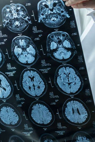 Doctor examining a brain scan on a large poster